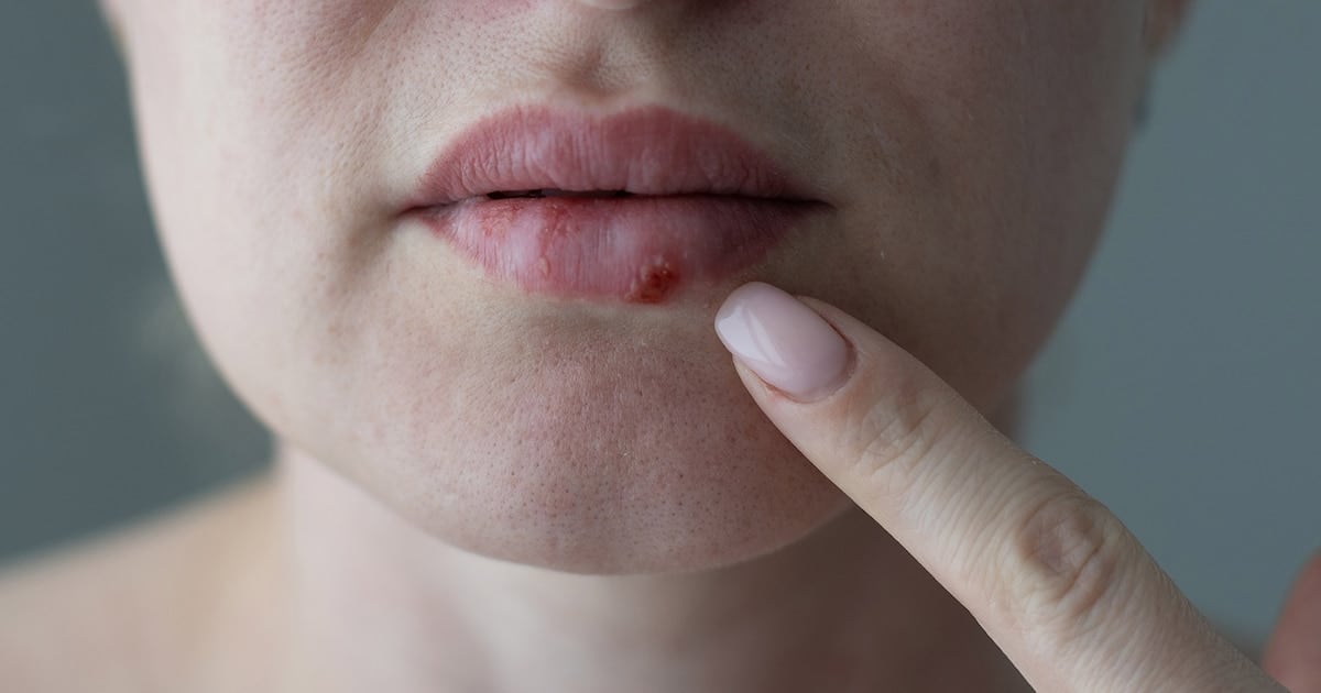 Hovilpri: la pastilla que reabre la esperanza para los pacientes con herpes que no respondían a ningún tratamiento