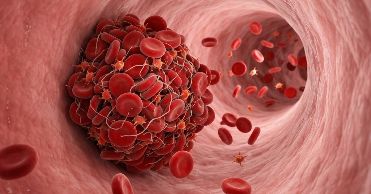 Cuando la sangre se detiene: cómo identificar a tiempo un coágulo que puede cambiarlo todo