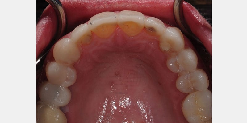 Carillas dentales: los sinais ocultos de una filtración y cómo actuar a tiempo
