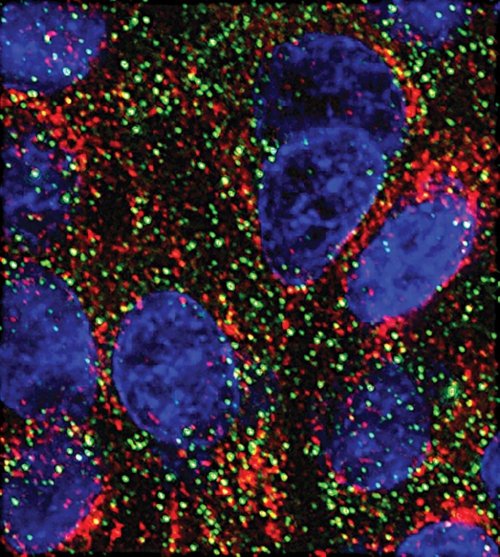 MicroARN frenan células de cáncer de páncreas en un avance de laboratorio